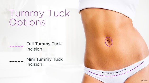 tummy tuck procedure