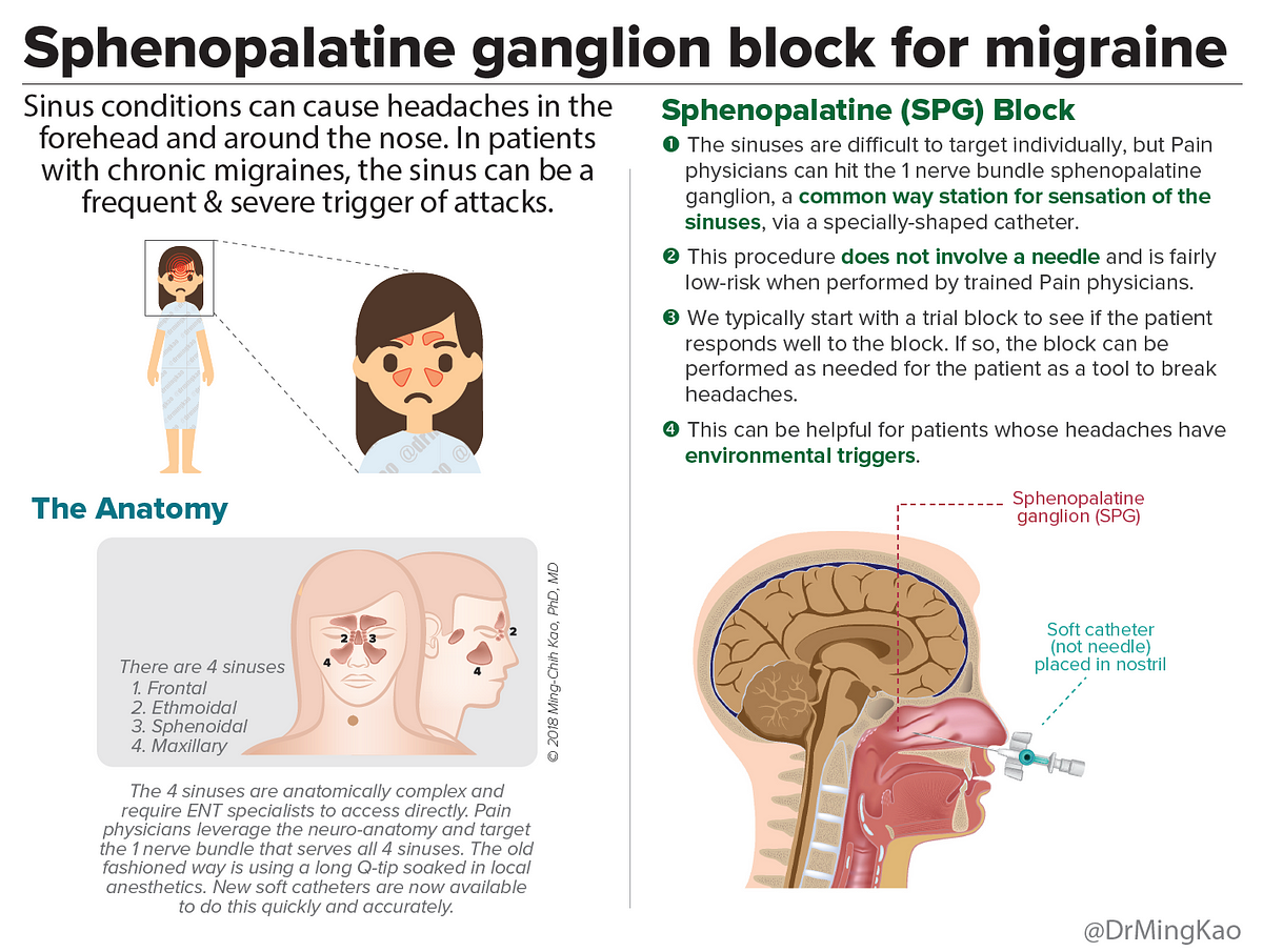 Sphenopalatine block for chronic migraine – Within Normal Limits of ...