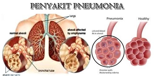Image result for penyakit pneumonia