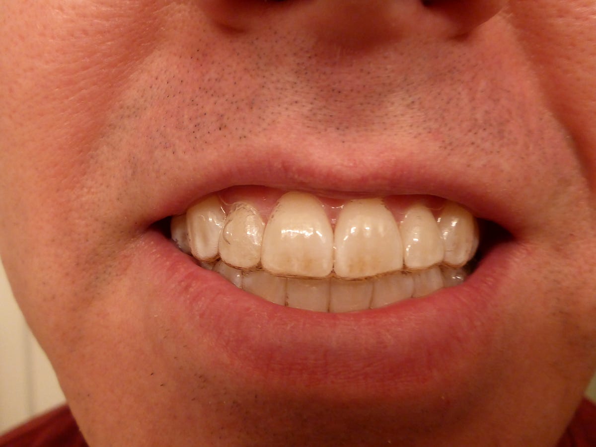 invisalign wearing attachment aligners tooth medium jason adventure