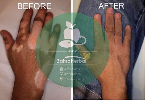 Obat Vitiligo Yang Ada Di Apotik Tia Novia Medium