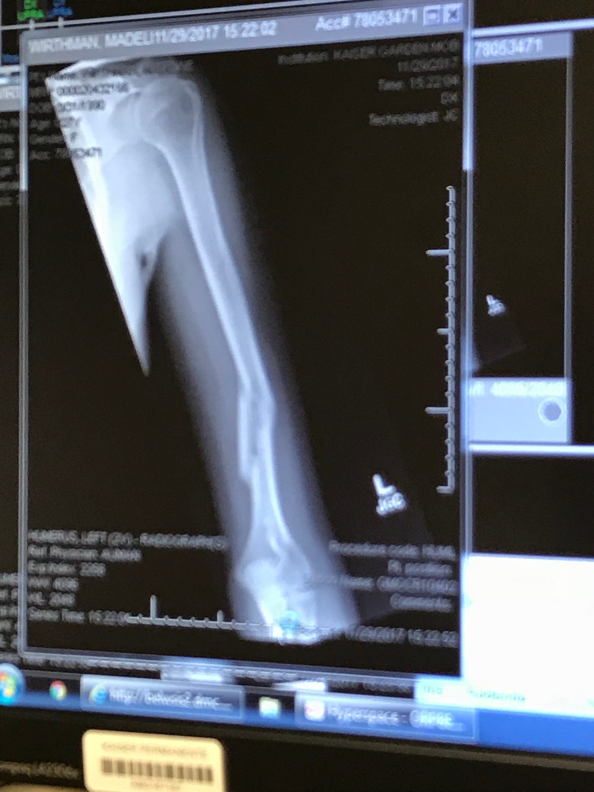 A Broken Humerus — Road to Recovery Maddie Wirthman Medium