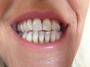 Fix Receding Gums Without Surgery — Dr. koinakm Hoya — Medium