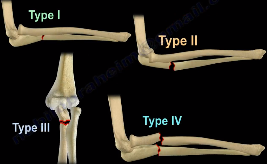 Monteggia Fractures – Nabil Ebraheim – Medium