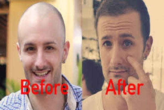 SUCCESSFUL HAIR TRANSPLANT – Dennis – Medium