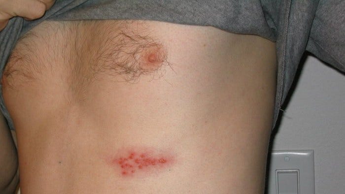 First Symptoms Of Shingles That Should Not Be Ignored   1*GkRjEXeswkfRy3prSsjLKw 