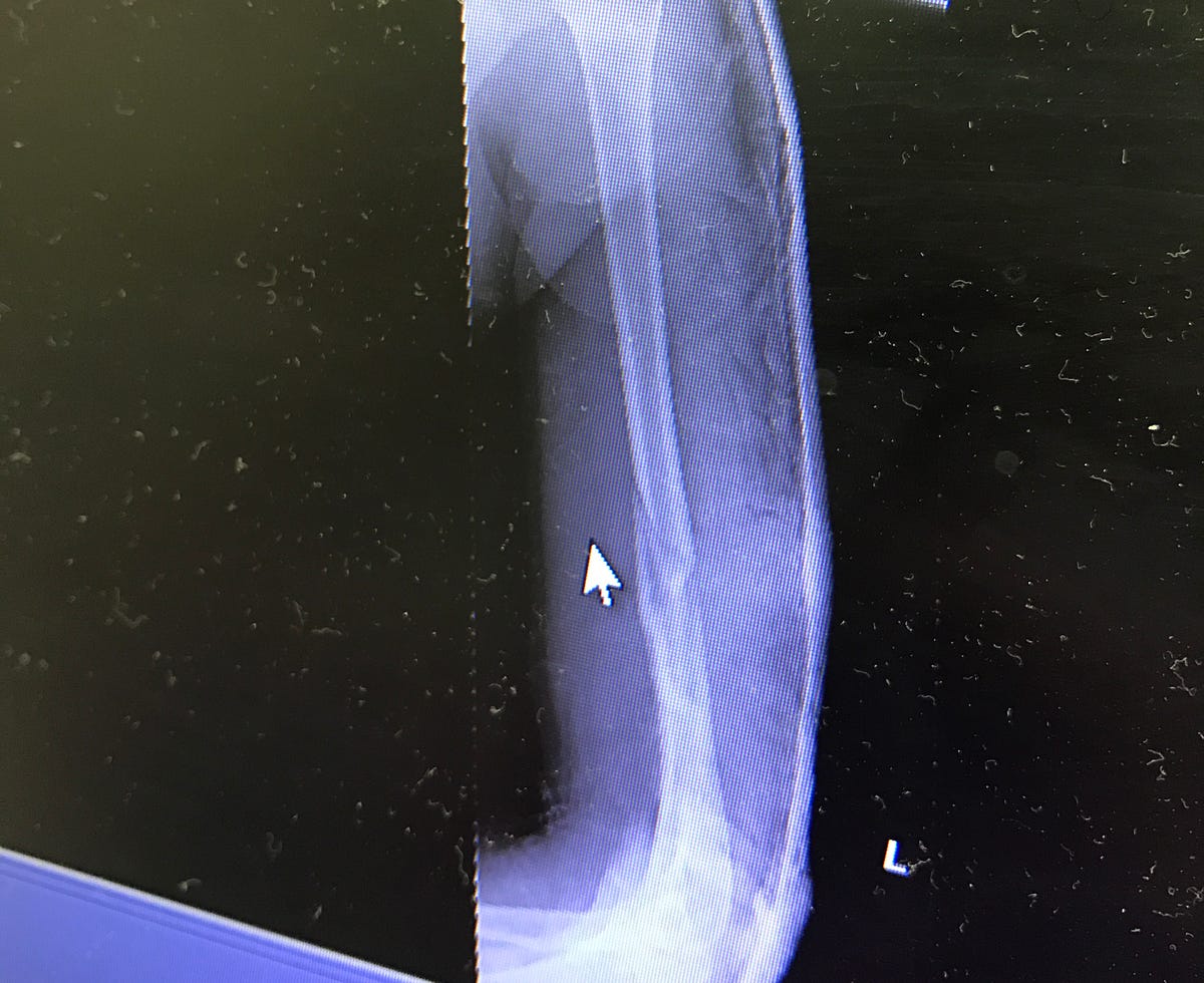 A Broken Humerus — Road to Recovery Maddie Wirthman Medium