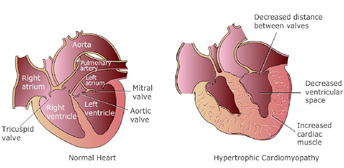 Heart Disease And Low Blood Pressure