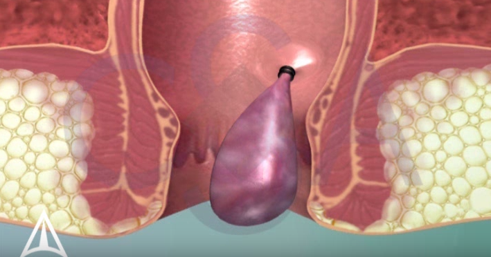Was sind Hämorrhoiden? Hämorrhoiden Medium
