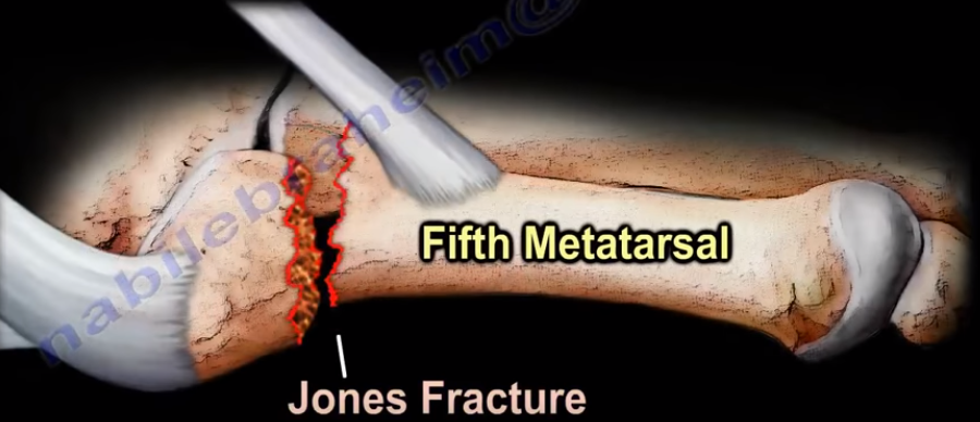 Jones Fracture- Fracture of the 5th Metatarsal Bone