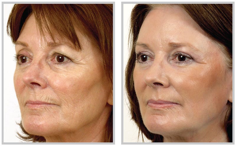 laser rejuvenation facial Laser rejuvenation facial