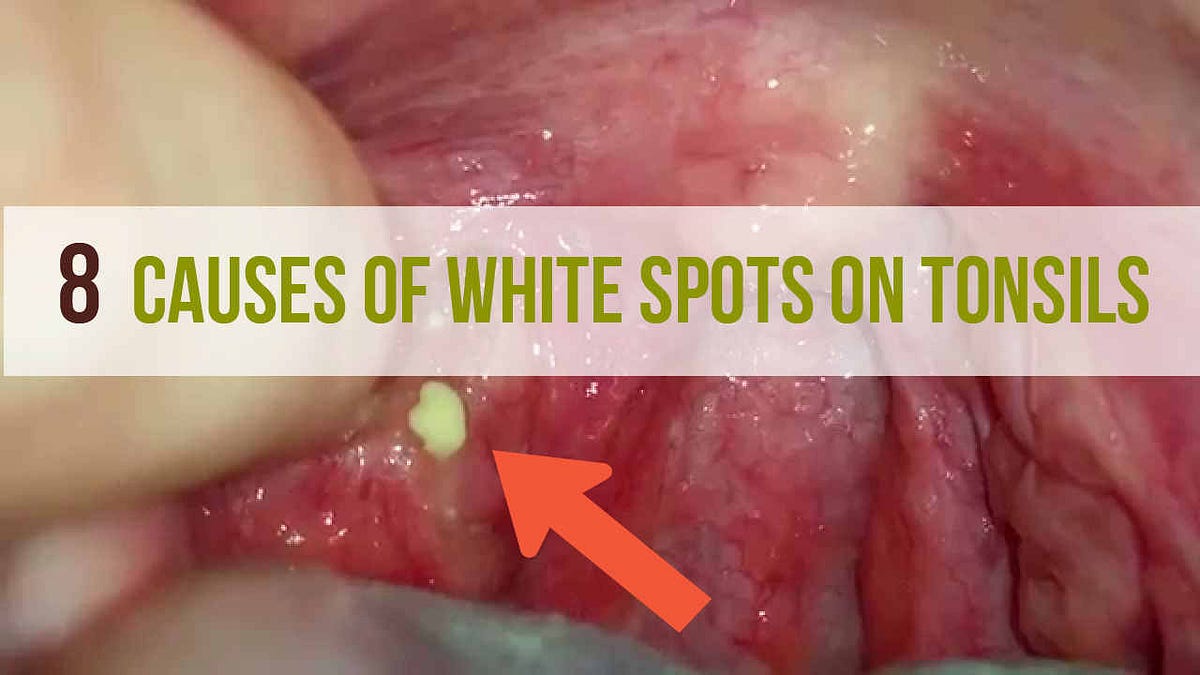 8 Causes Of White Spots On Tonsils | Images and Photos finder