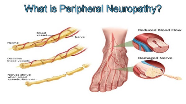 Dr. Tad Tenney | What is Peripheral Neuropathy? – Dr. Tad ...