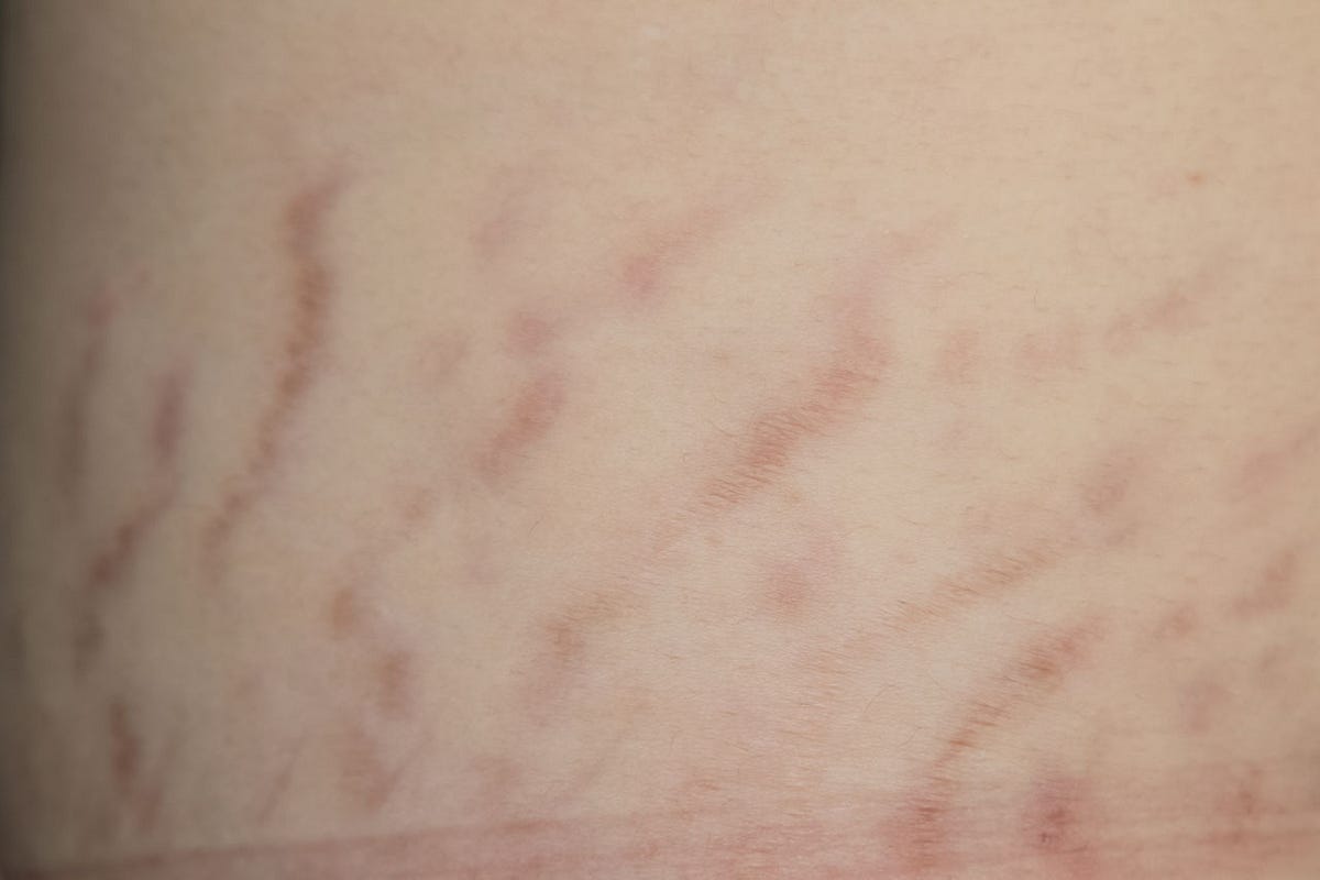 stretch-marks-causes-treatment-and-prevention-renita-rajan-medium