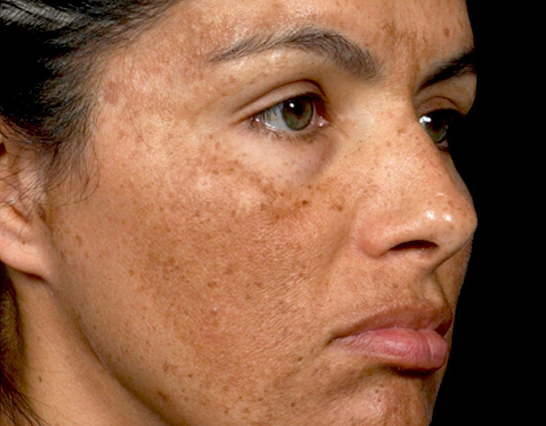 Face Discoloration Treatment Doctor Heck