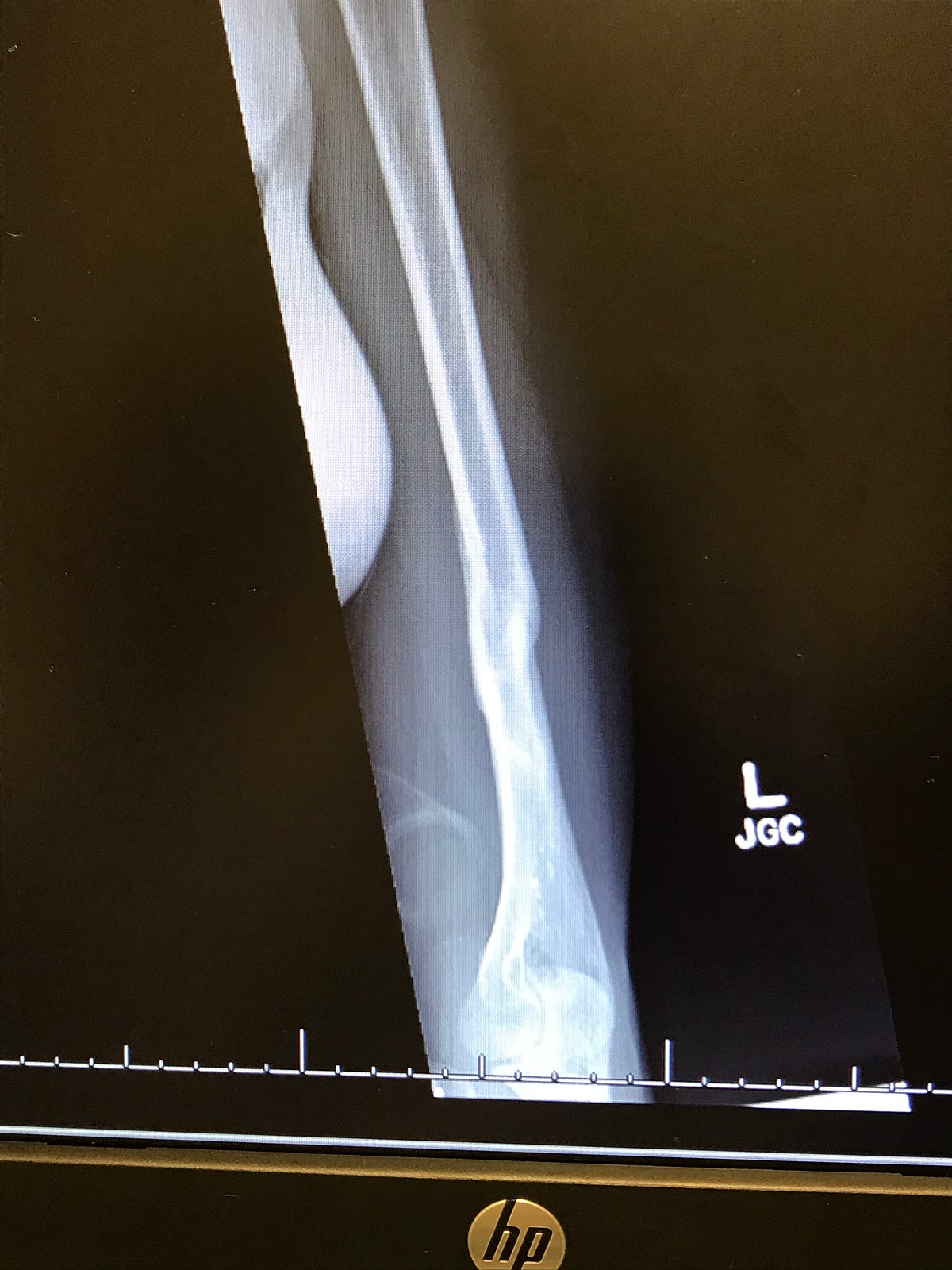 A Broken Humerus — Road to Recovery Maddie Wirthman Medium