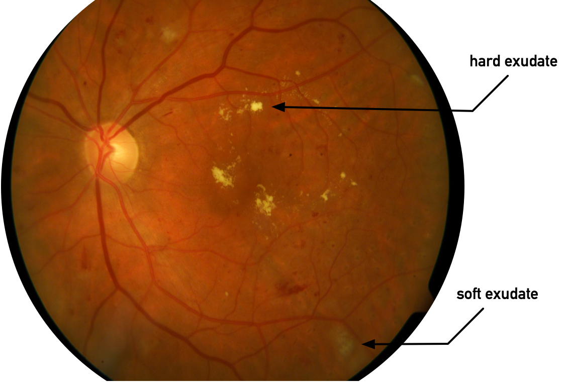 Growing Neural Gas For Good: Quantifying Hard Retinal Exudates In ...