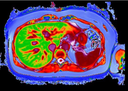 Multiparametric Magnetic Resonance Imaging (MRI) as a Safe ...