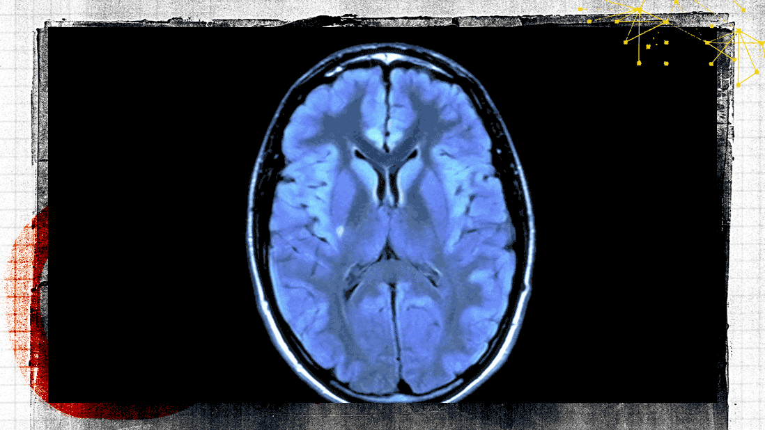 How One Researcher is Unfolding the Mystery of CTE UCSF Magazine Medium