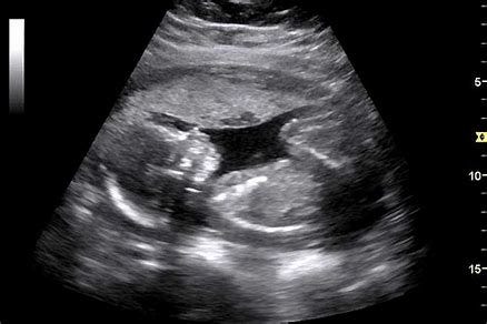 OBG’s Ultrasound