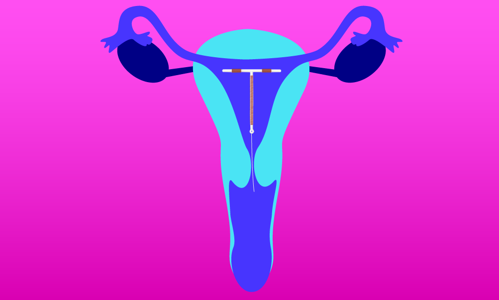 getting-a-copper-iud-part-2-the-procedure-tabu