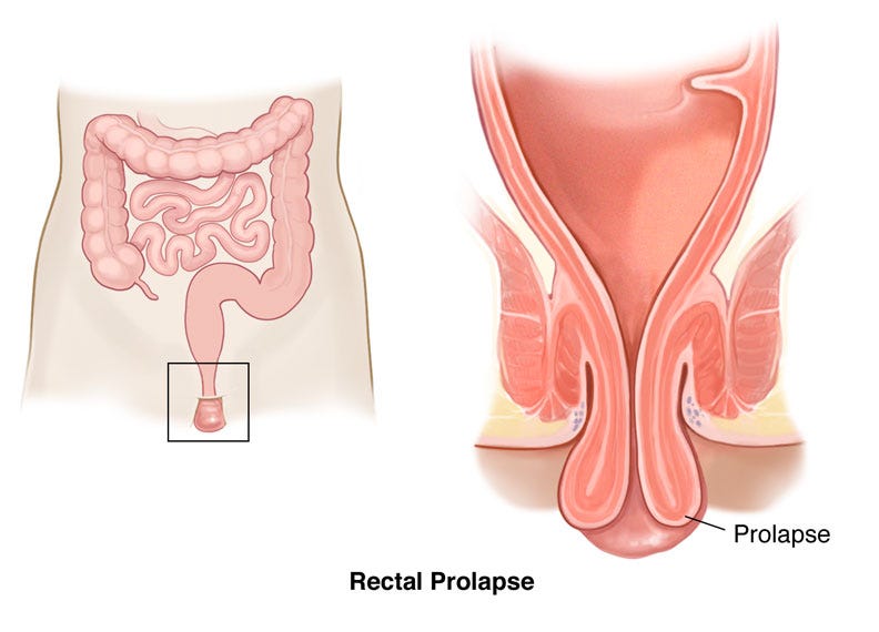 rectal prolapse symptoms rectal prolapse symptoms