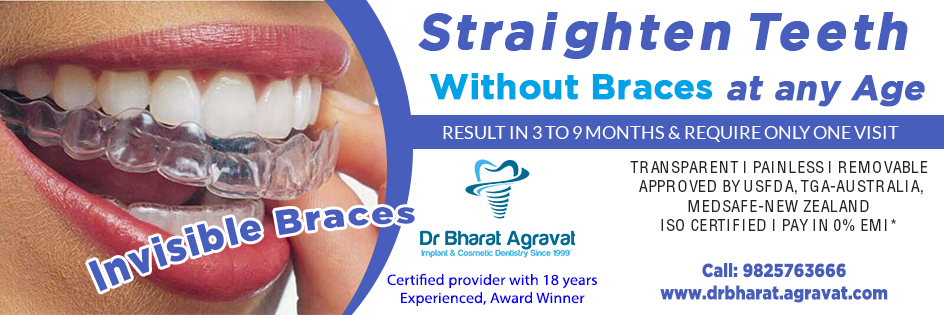 Invisible Clear Braces For Teeth Cost Price Reviews Pros Cons Before After From Indias Leading 6078