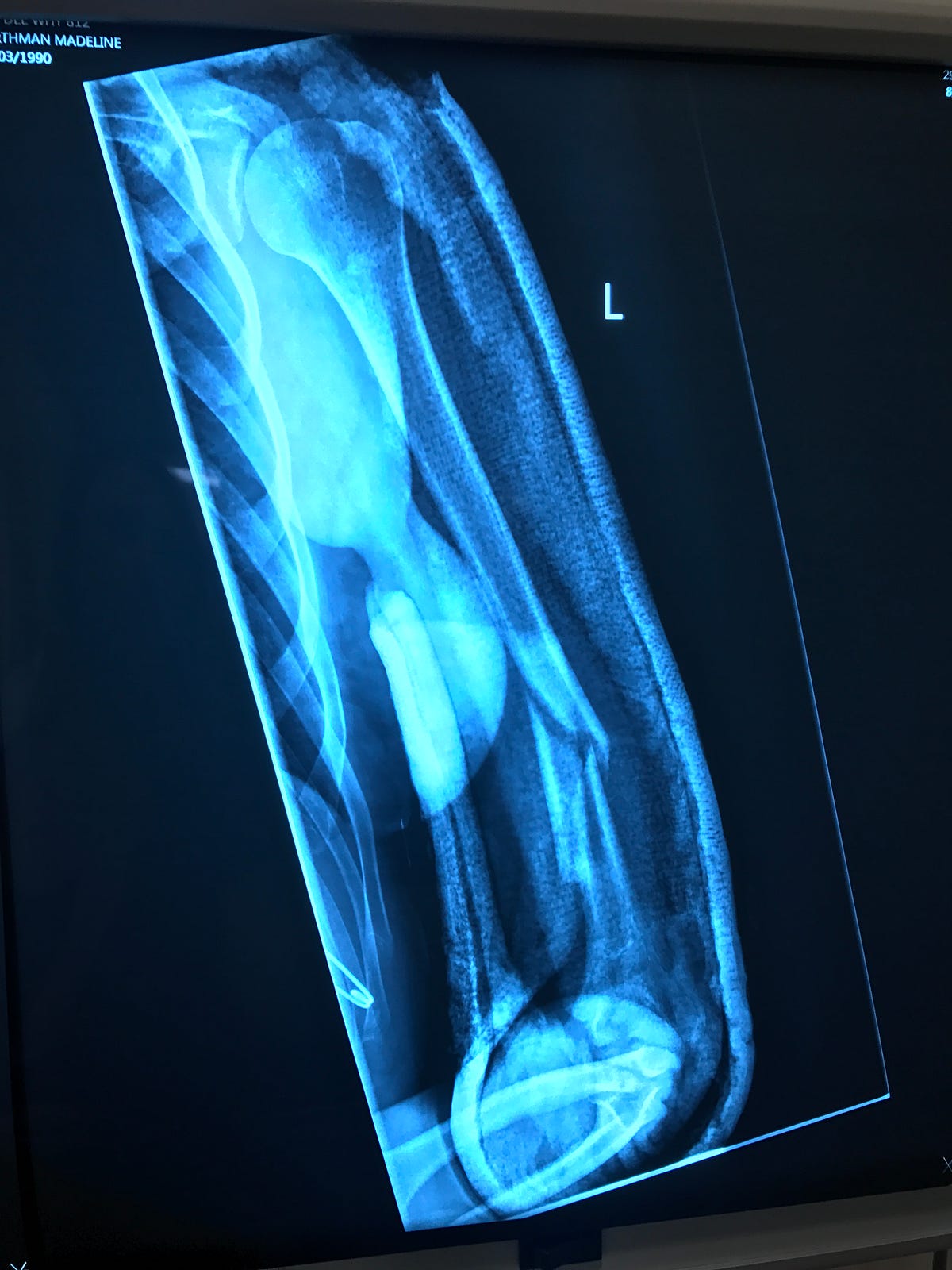 A Broken Humerus — Road to Recovery Maddie Wirthman Medium