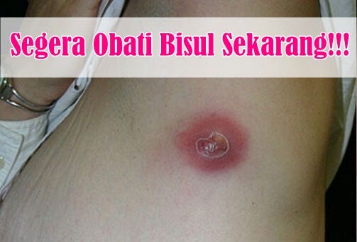 7 Obat Salep Bisul  Ampuh Pada Bayi Balita Dewasa di Apotik