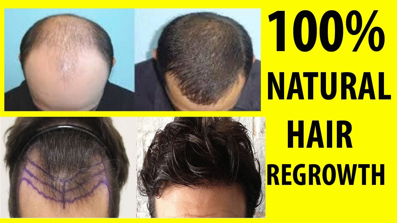 NutraVigour Regrow Reviews A Best Hair Growth Formula No Side
