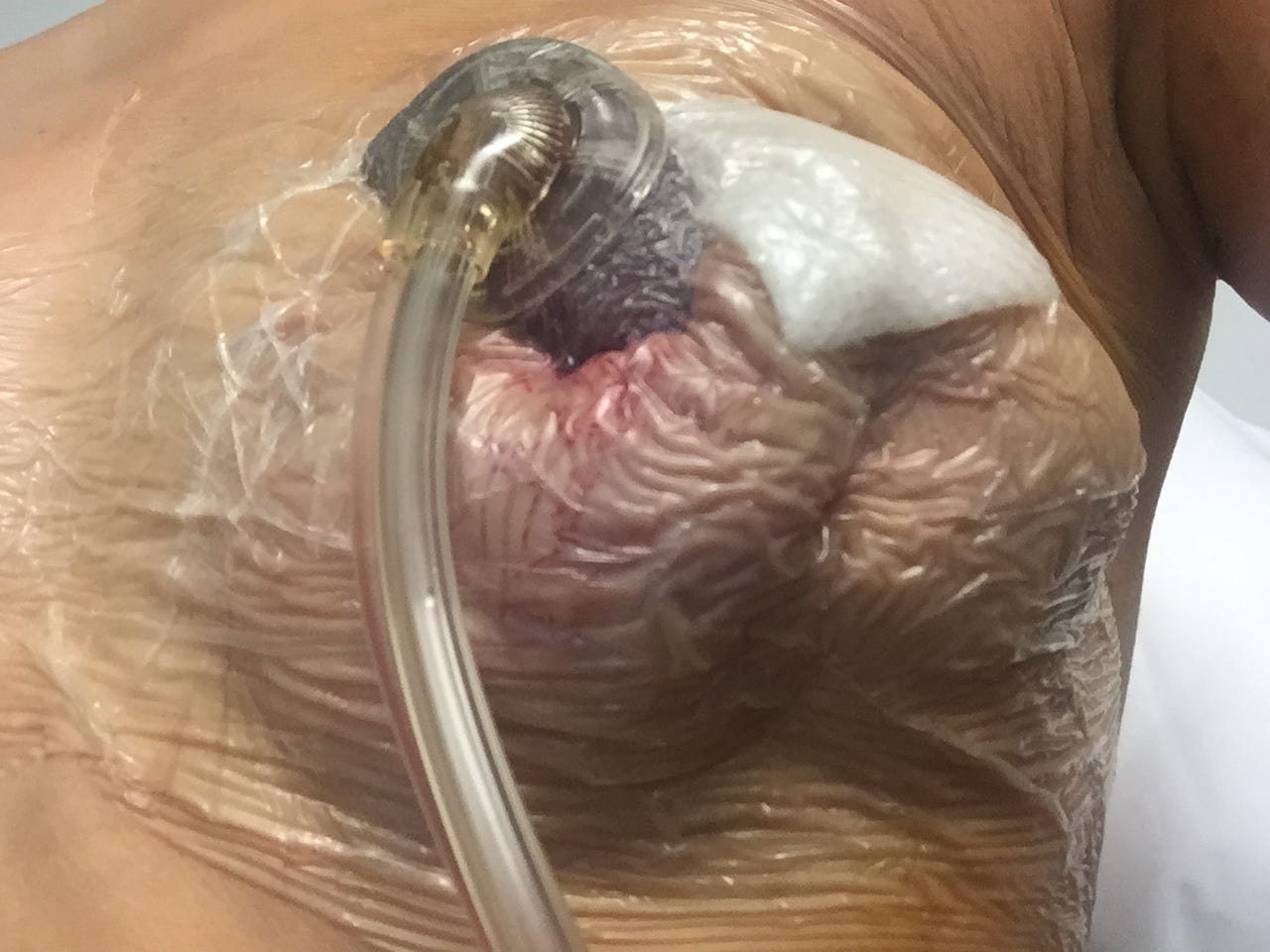 breasts rupture on flight Breasts rupture on flight