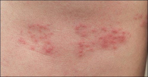 Obat Herpes Yang Sudah Kering Herpes Cepat Kering Medium