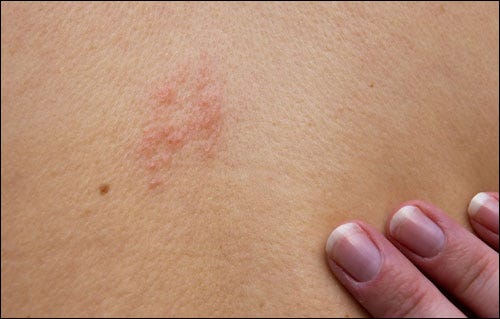 Obat Herpes Kulit Yang Bagus Herpes Cepat Kering Medium