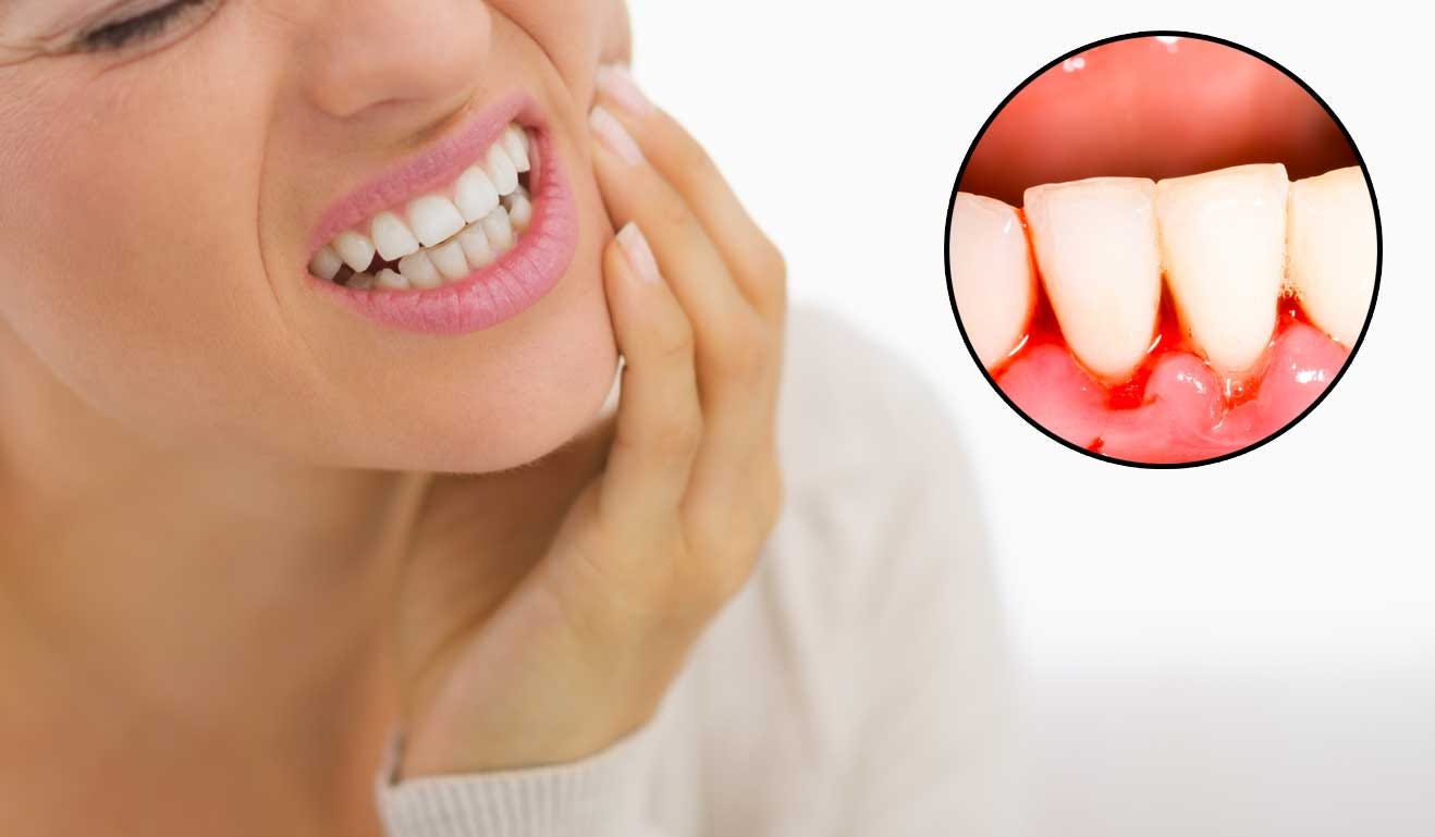 What to do if bleeding gums What to do if bleeding gums