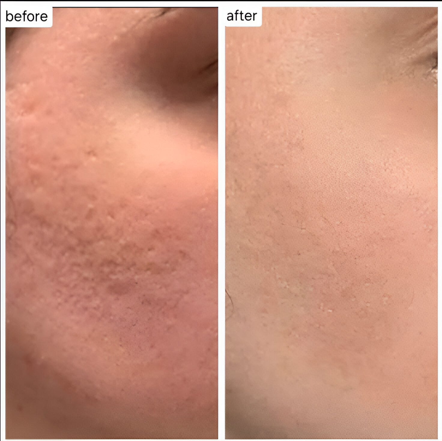 RF Microneedling for the Neck at Athira Spa and Clinic, Altrincham