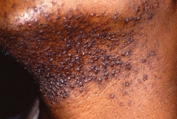 pseudofolliculitis