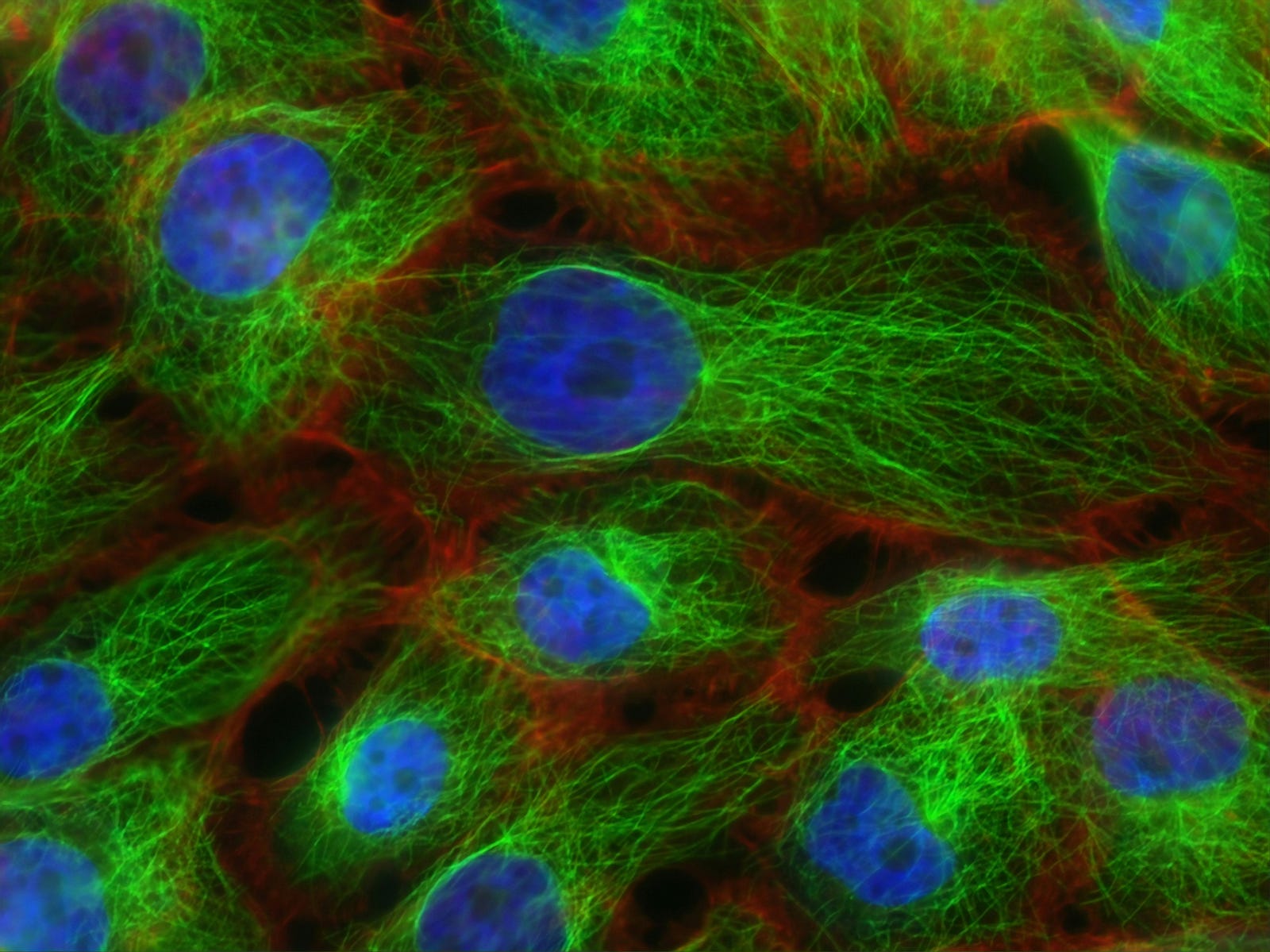 Breast cancer cells seen with fluroscent dye staing the nucleus blue and the rest of the cell bright green.