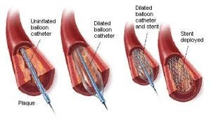heart stent illustration