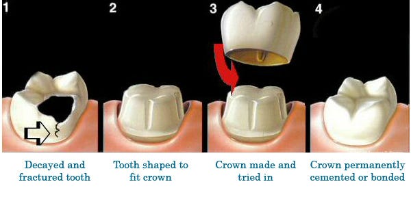 What Is The Procedure For Dental Crown? – Stories Of Healthticket.co ...