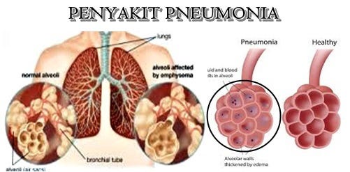 Obat Herbal Alami Menyembuhkan Penyakit Pneumonia Agen Obat Herbal Alami Menyembuhkan Penyakit Pneumonia Agen