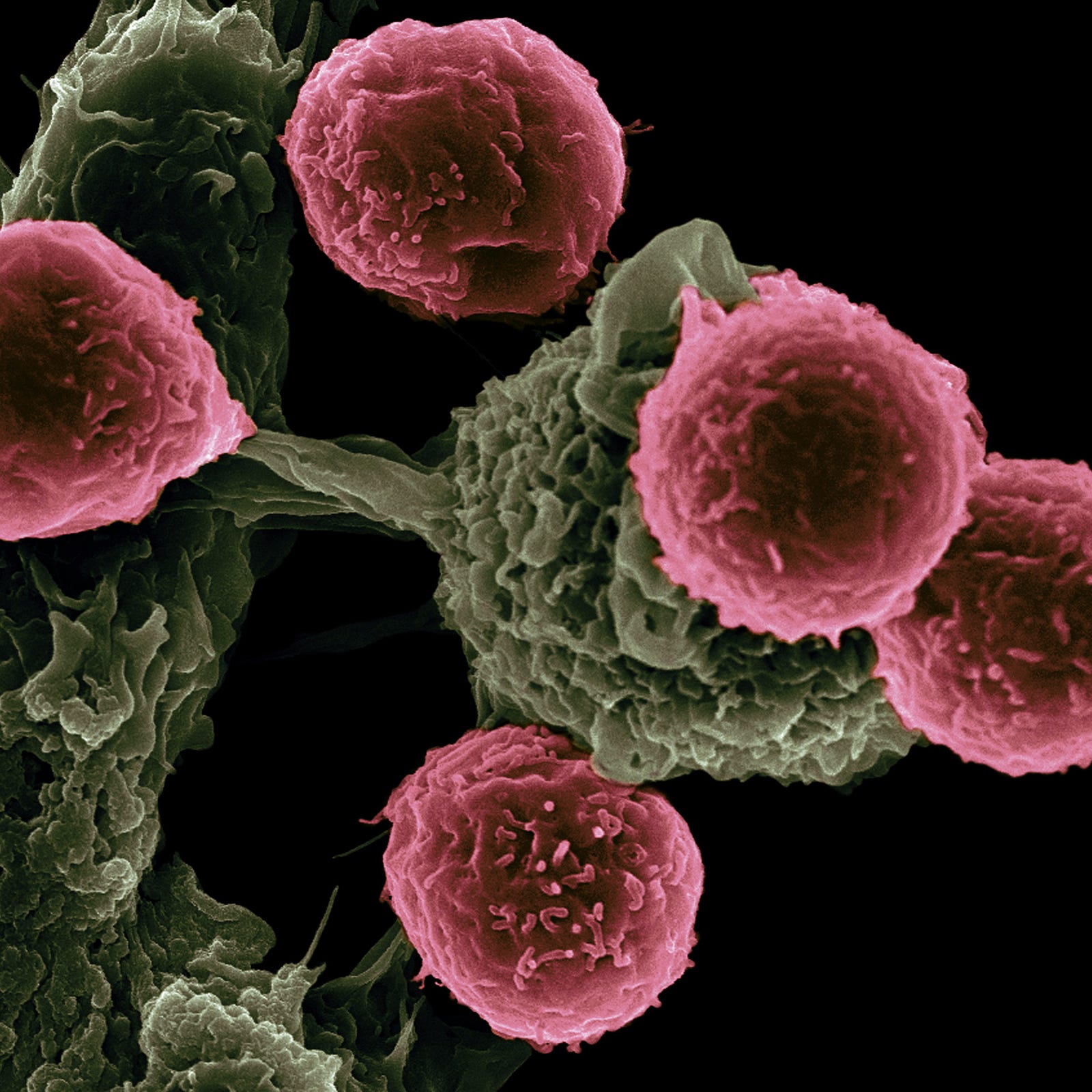Photomicrograph of a cancer cell, surrounded by immune system T-cells. Researchers have found that looking at the immune system’s activity in and around the tumor can help predict how well patients with early-stage lung cancer will do after surgery.