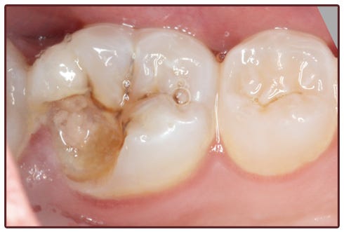 How Long Do Sealants Last on Your Teeth? - William Miller ...