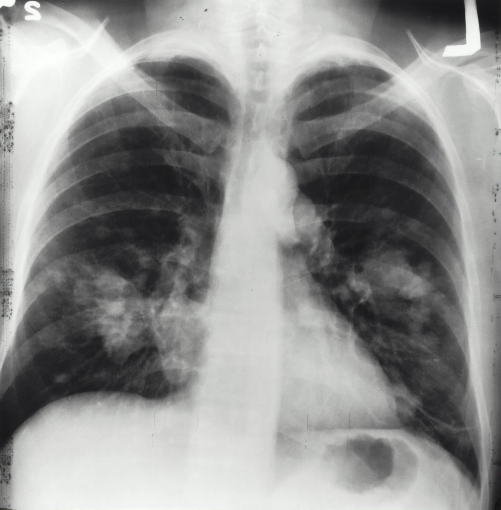 A chest X-ray of advanced stage lung cancer.