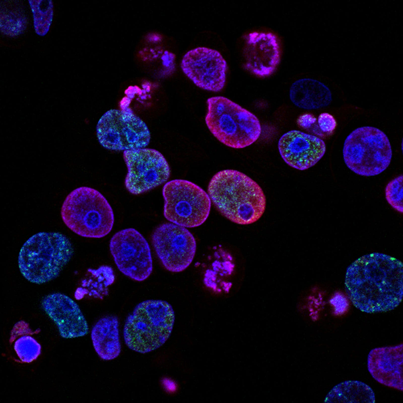 A photomicrograph of purple-colored cancer cells. I can imagine using these fluids to detect cancer or monitor known malignancies. Collecting a saliva sample could be as easy as spitting into a tube.