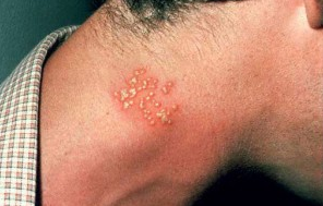 Cara Menyembuhkan Penyakit Herpes Di Leher Mengatasi Penyakit