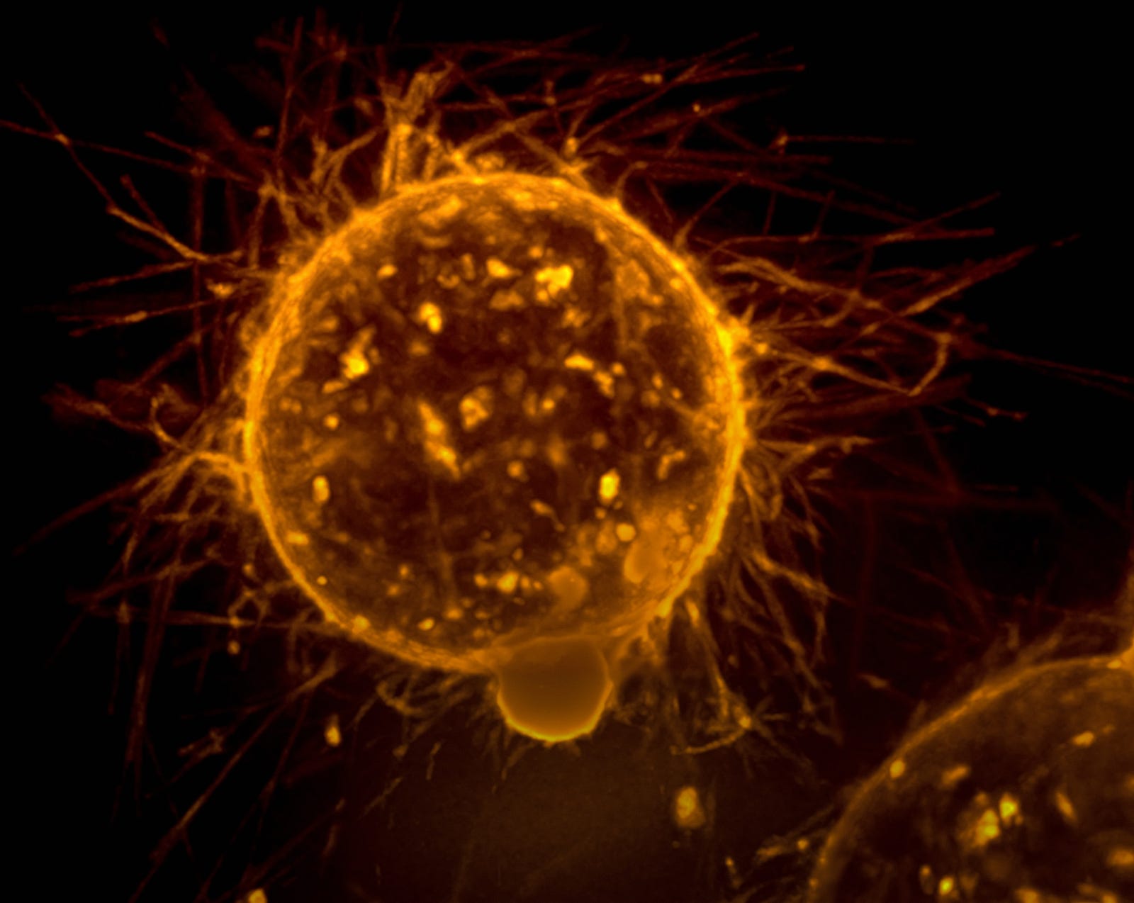 A photomicrograph of a cancer cell. Individuals at average risk should start colorectal cancer screening at age 45.