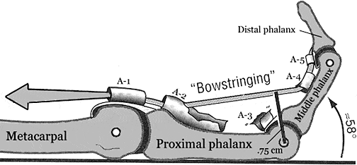 A2 Pulley Injuries In Rock Climbing Dr James Lee Pt Dpt Faaompt Medium