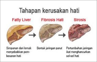 Solusi Atasi Penyakit Liver 100 Yang Manjur Ilmia Alima Medium