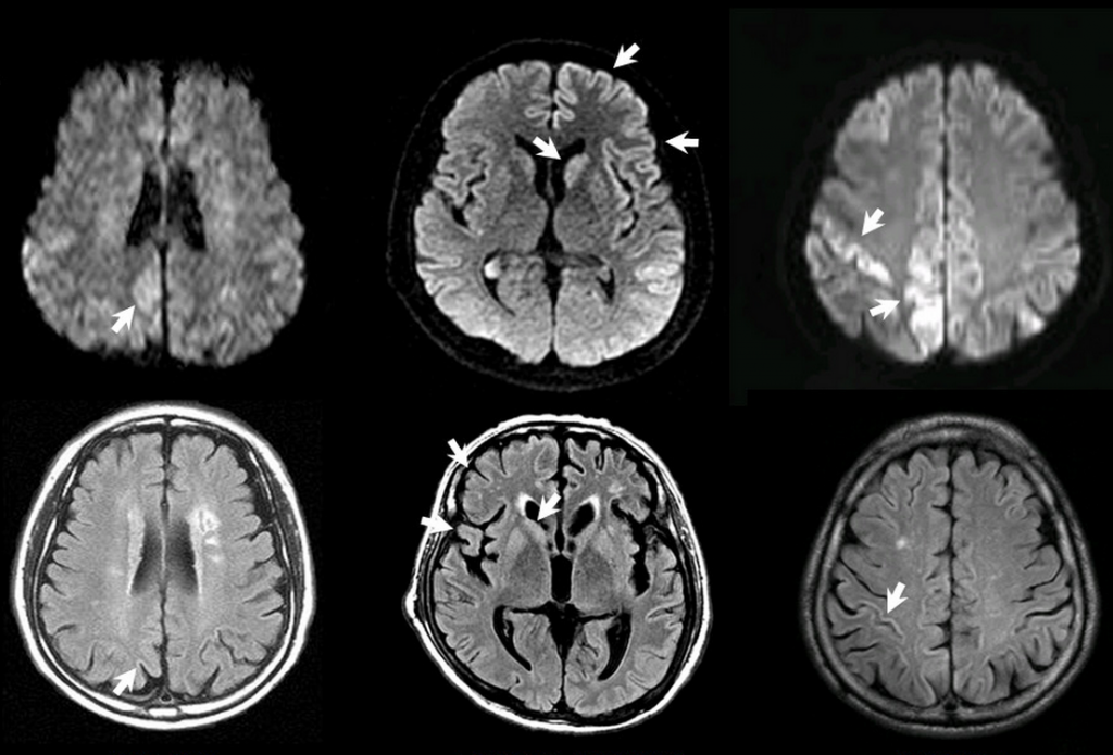 a-new-hope-for-prion-disease-diagnosis-nu-sci