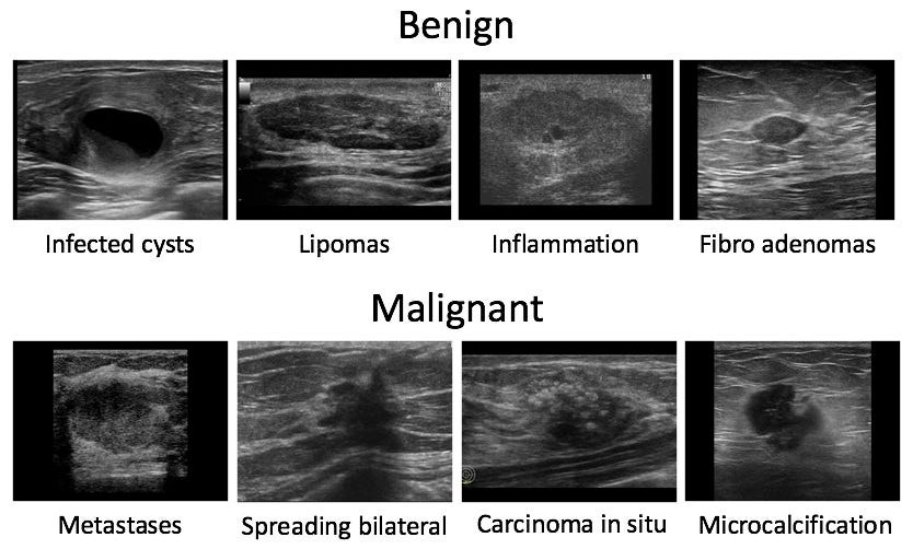 Automating Breast Cancer Detection with Deep Learning